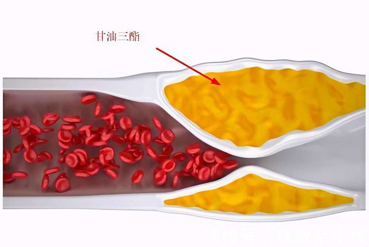 甘油三酯|甘油三酯高了就要吃药?医生:错了,达到一定的数值才要吃降脂药
