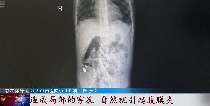 纽扣电池|警惕！三岁“熊孩子”肠道穿孔险丢命，竟因…