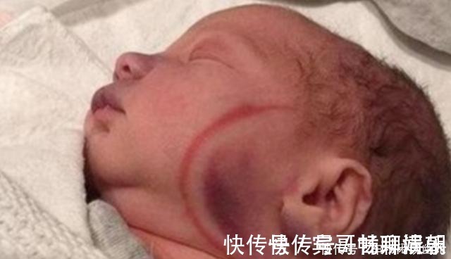 医生|剖腹产划伤宝宝脸颊，医生安慰“问题不大”，2个月后父母找说法
