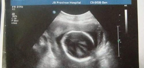 孕妈们|通过产检B超单的“肾盂分离”,可判断胎儿性别还真有一定道理