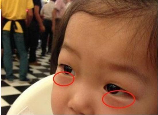 眼袋|孩子积食不消化,脸上3个异常不会“撒谎”,希望娃一个不占