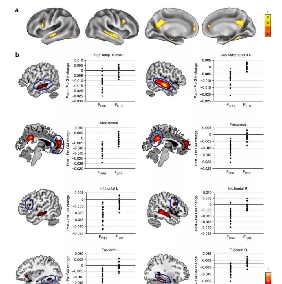 金如|怀孕会改变大脑!“孕傻”是真的?真相和你想的不一样