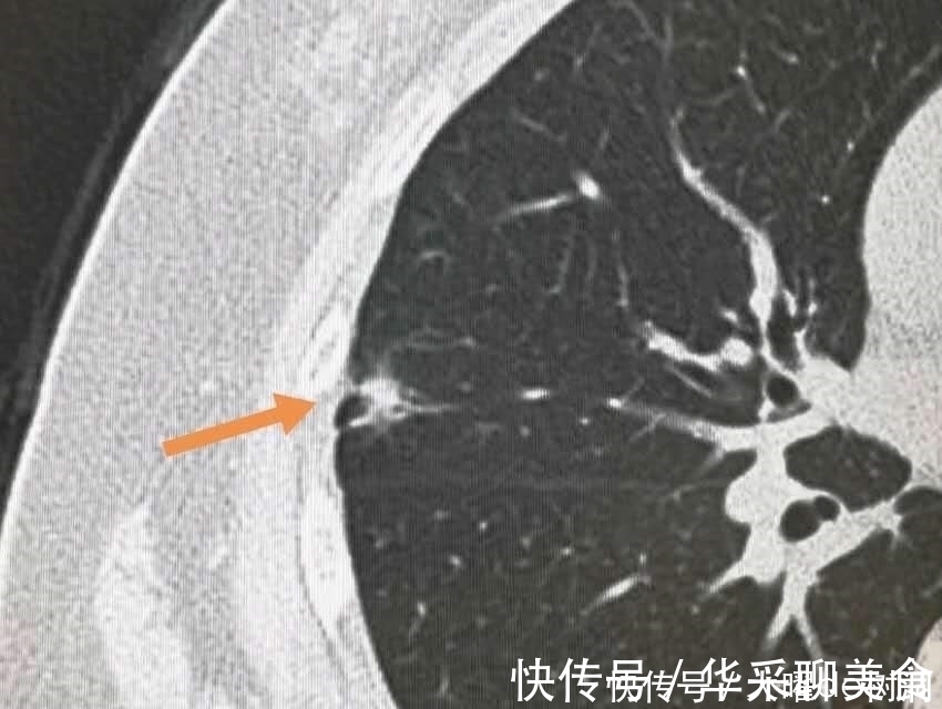 体检|年年体检，为什么还得了晚期肺癌？体检有啥用！
