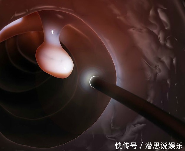 两种息肉一定要及时切除，拖五年以上可能变成恶性肿瘤