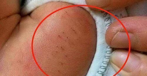 妈妈|妈妈发现宝宝的背上长满了''黑刺'',把刺一根根拔掉,医生检查后大骂无知