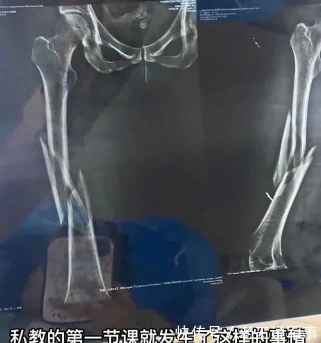 股骨干|女子第一次上私教课,练瑜伽被教练压断大腿!网友:下手太狠了!