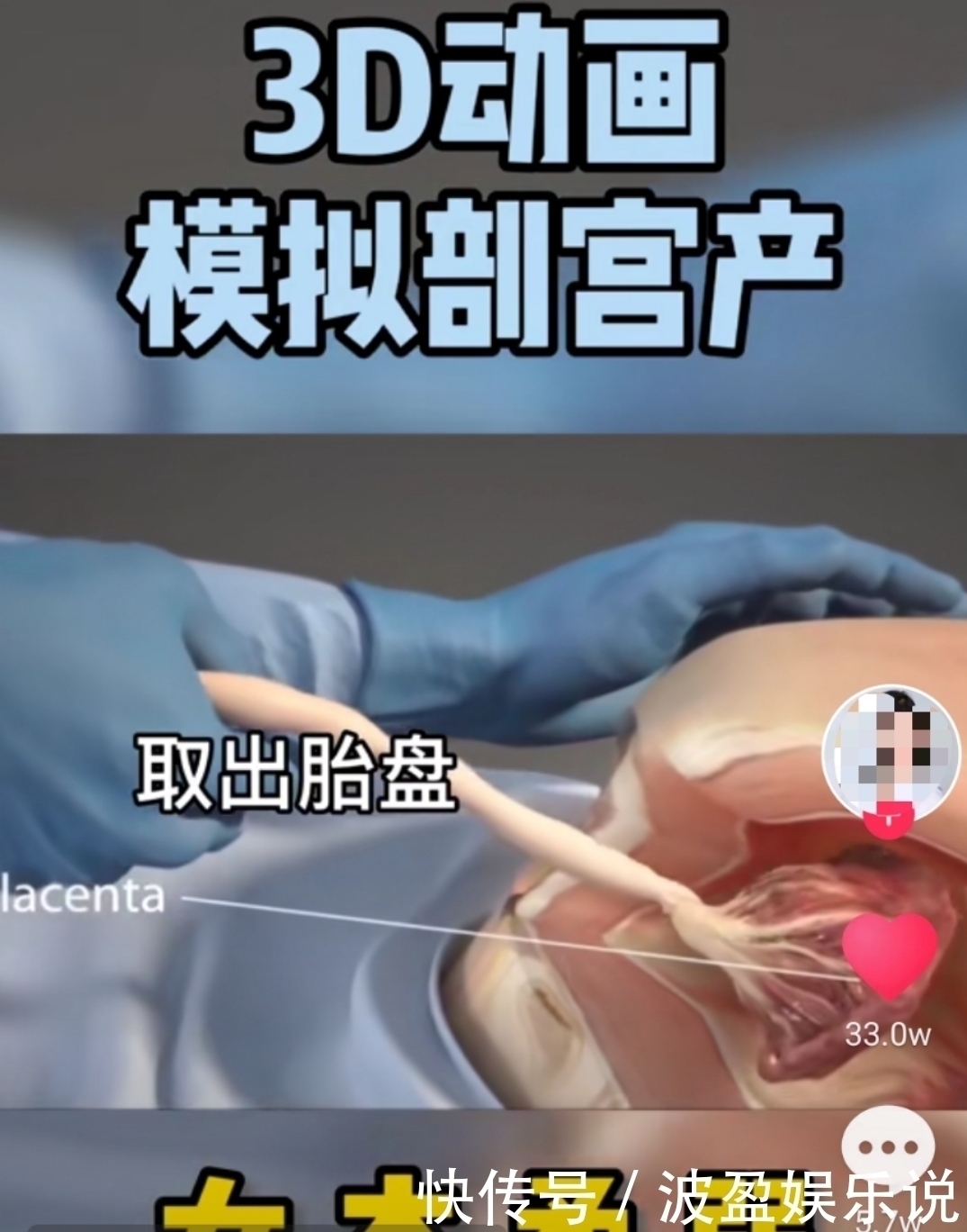 麻醉|剖宫产有多“伤”妈妈,几张3D过程图带你了解,感恩老婆和妈妈