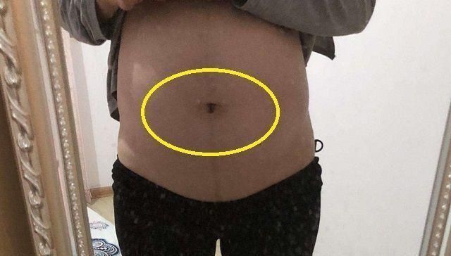 状况|孕妈的肚脐，凸出来好还是凹进去好如果是这种状况说明很有福气