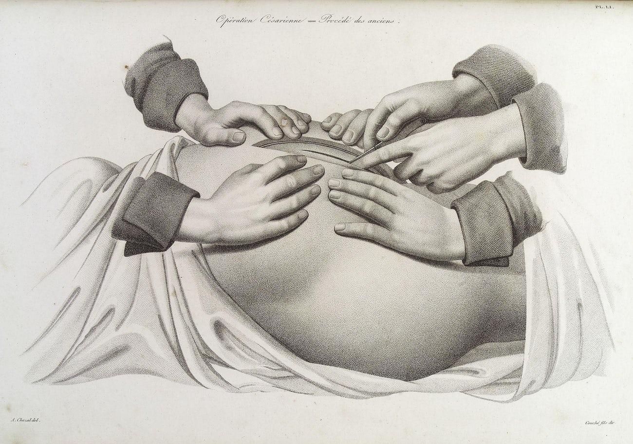 手术|英国“花木兰”：女性被允许行医前，她假扮男性做了几十年手术