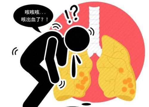  肺癌|当以下4个症状找上自己时，肺癌或已进入了中晚期，及时就医