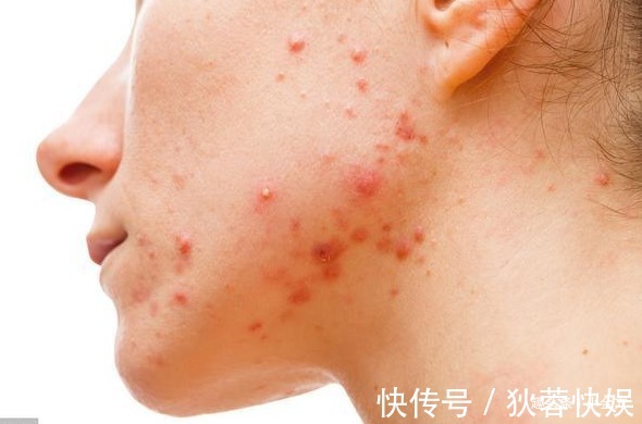 豆豆|小小一粒“豆”,内服治脚气水肿,外敷搞定痤疮,等十几种皮肤病