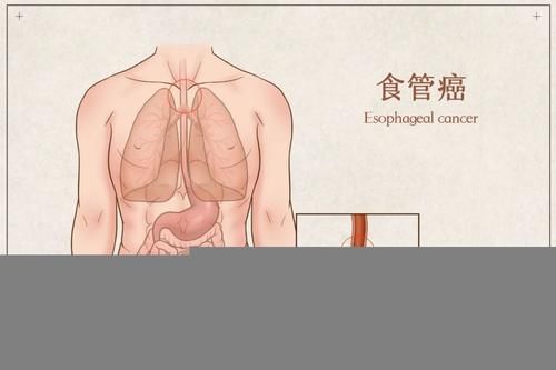  嗓子眼|总觉得嗓子眼有东西，咳又咳不出？医生：赶紧做胃镜