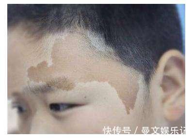 血管瘤|要想宝宝出生后不长胎记,孕期避免这几件事就OK,你做到了几条