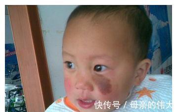 生活习惯|胎记:最喜欢3种孕妇,孕期常做这些事,难看的胎记就会找上宝宝