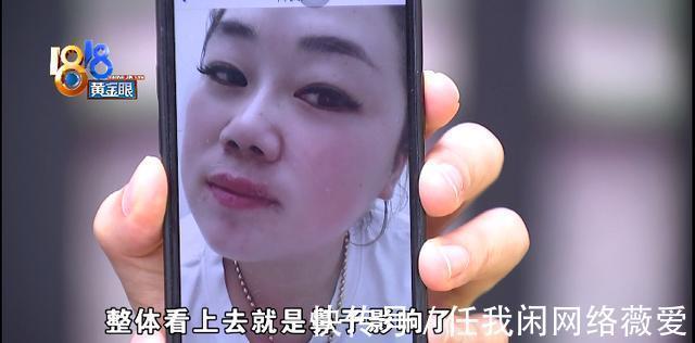 鼻头 做了两次手术,现在两个问题