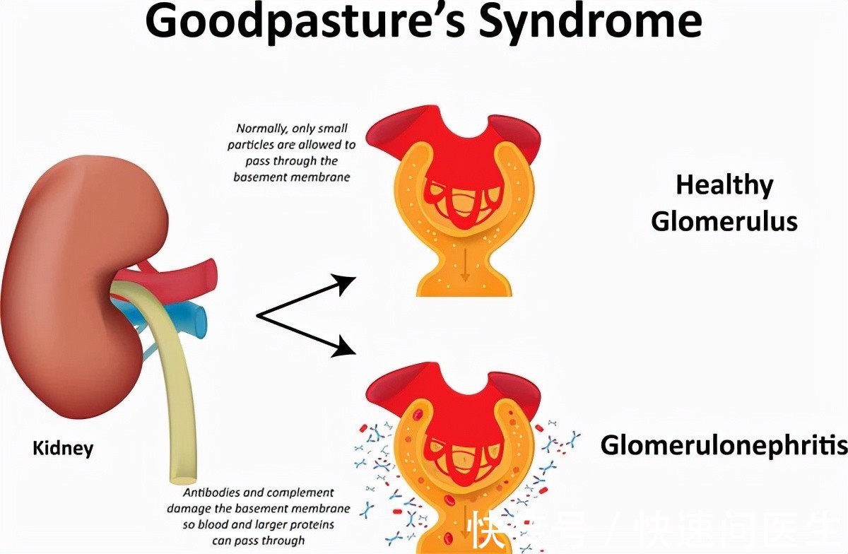 肾病|糖尿病并发症多,预防糖尿病肾病,做好3点很重要