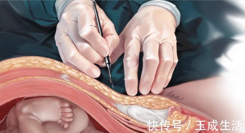 杨院长|女人可以做几次剖腹产不是三次和五次,医生不要超过这个数