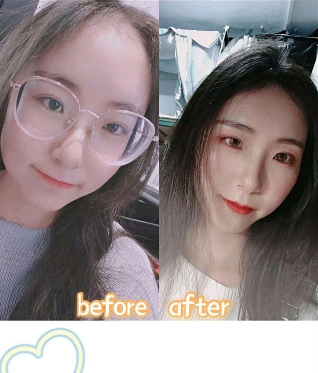 植发 剃发和不剃发植发,应该怎么选!