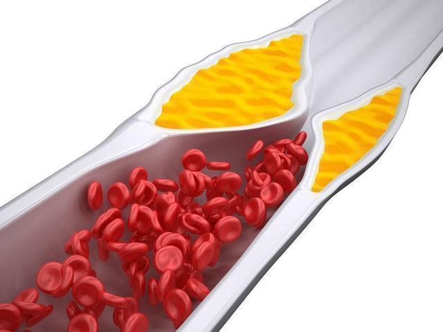 手掌上的这些信号预示血栓,如果不注意当心引发心梗