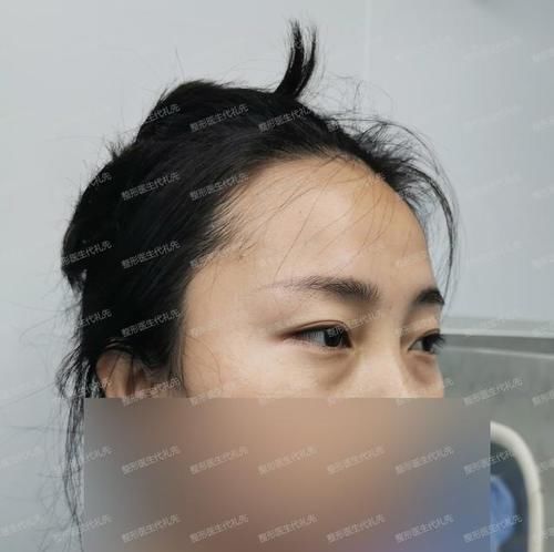 38岁做了眼周年轻化手术,看我眼周的变化,给计划做的人一个参考