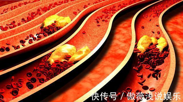 血脂|高血脂分3种:有的需要吃药,有的不需要吃药,这一点需要明确