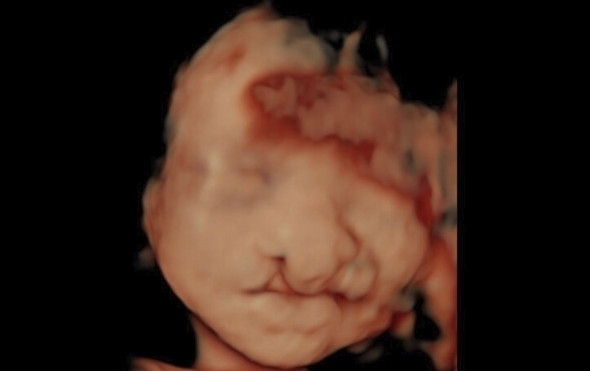 唇裂|天生唇裂女子整容后怀孕 医生建议打掉,她却做了一个惊人的决定