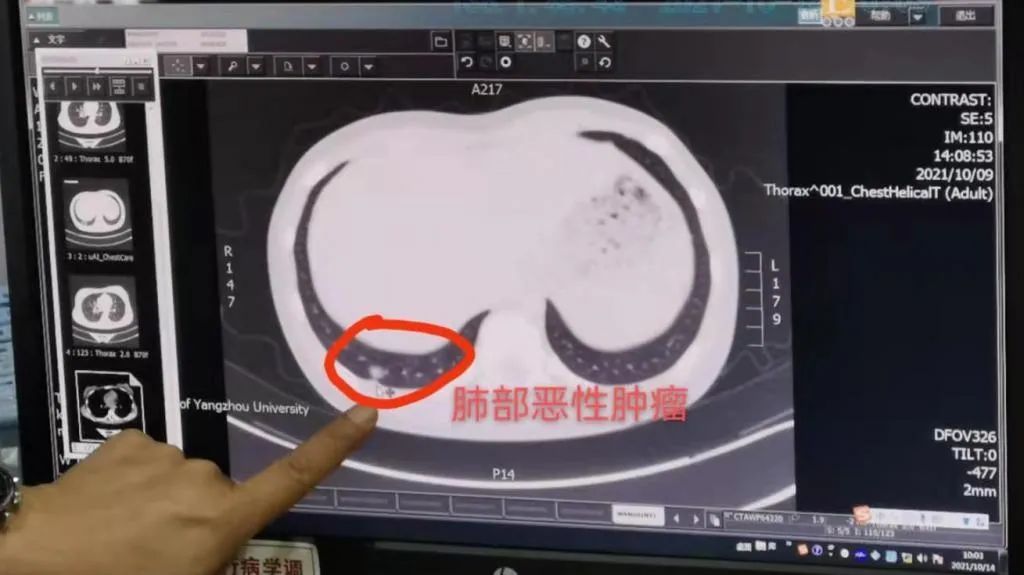 高烧|11岁女孩突然高烧不退、咳嗽!医生:肺癌