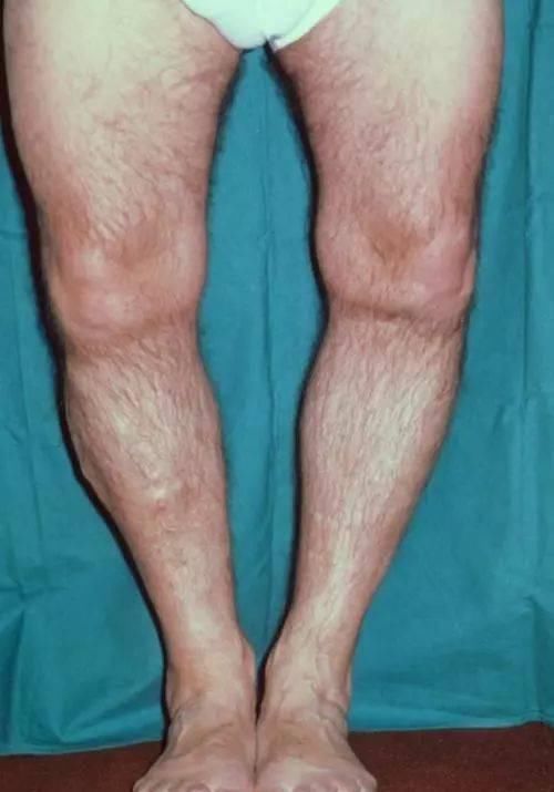 苏子油|9岁男孩排不出尿,查出肾衰,医生说孩子这几处不能随便打