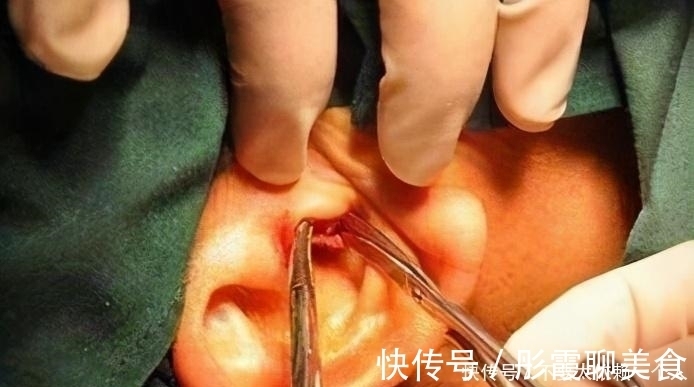 医院|孩子生下来就没掏过耳朵,又长又宽的耳屎堵住耳道,家长需警惕