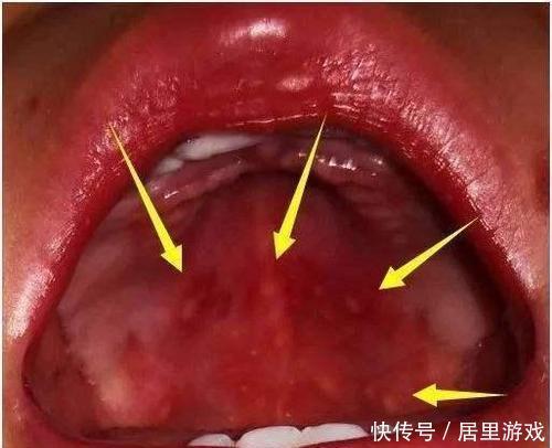 静脉补液|宝宝得了疱疹性咽峡炎该怎么治疗