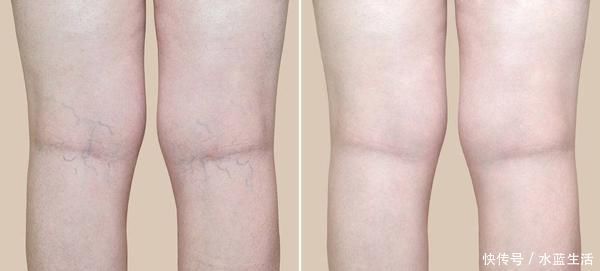 雌激素|雌性激素对女性有多重要?提醒:都有这些好处,学会合理补充