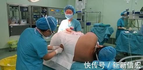 超重|超重产妇产房四道难关后,生下82斤巨婴,手术刀口全是油