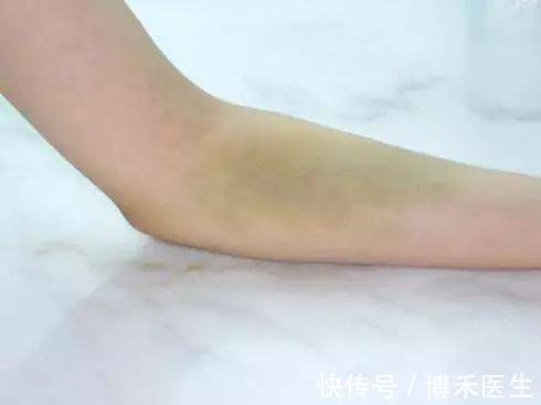 凝血功能|体检抽血伤口肿了淤青有事吗