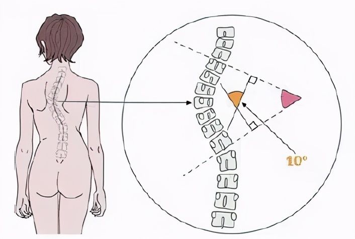 女孩|21岁女孩身体被折成70度！专家提醒：青少年需警惕脊柱侧弯