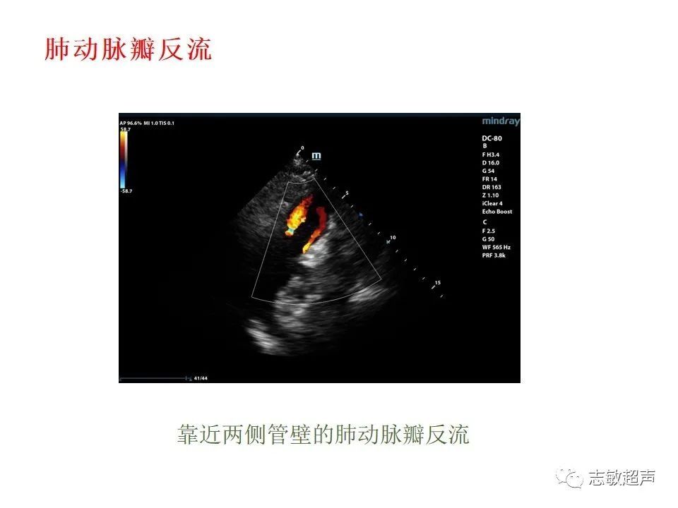 超声|肺动脉瓣周边异常血流的超声鉴别