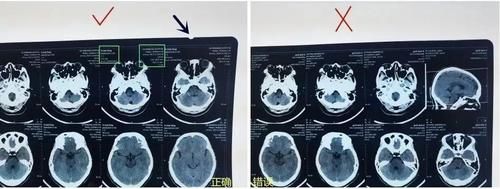  翻拍|如何留影像资料？如何翻拍影像学检查片子？