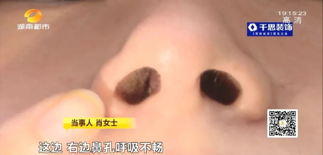 芯美昕|长沙一女子隆鼻后，多次睡梦中被憋醒！
