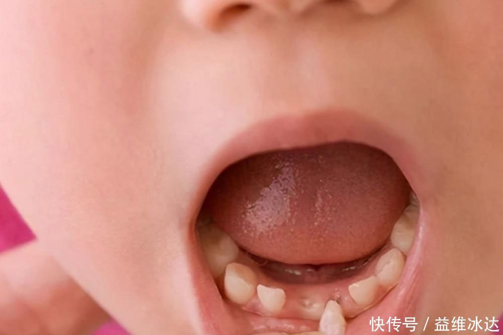 宝宝|宝宝的牙齿护理要上心,乳牙关键时候能“救命”?年轻父母需了解