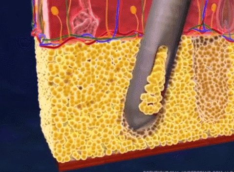 脂肪细胞 吸脂真的能做到想瘦哪里瘦哪里吗?吸脂术后都有哪些注意的呢?