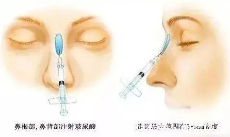手术 玻尿酸隆鼻可以维持多久?1年?术前准备+术后护理要知道的事!