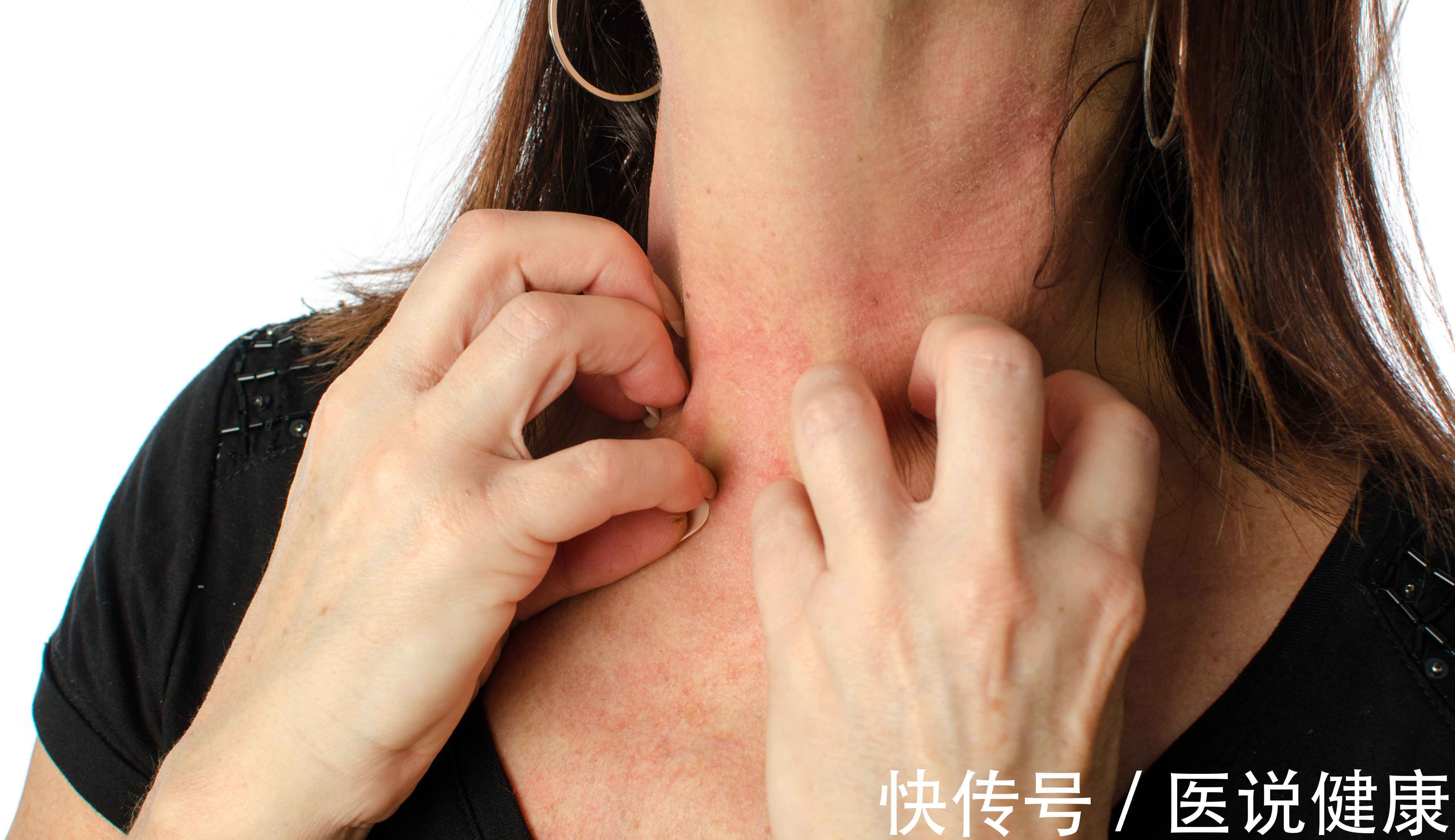 食物|过敏体质的人,这4类常见食物,要尽量少碰,需了解