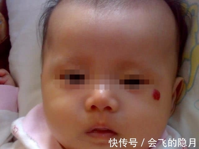 血管瘤|宝宝眉心有胎记,宝妈却不以为然,12个月宝宝送医抢救无效