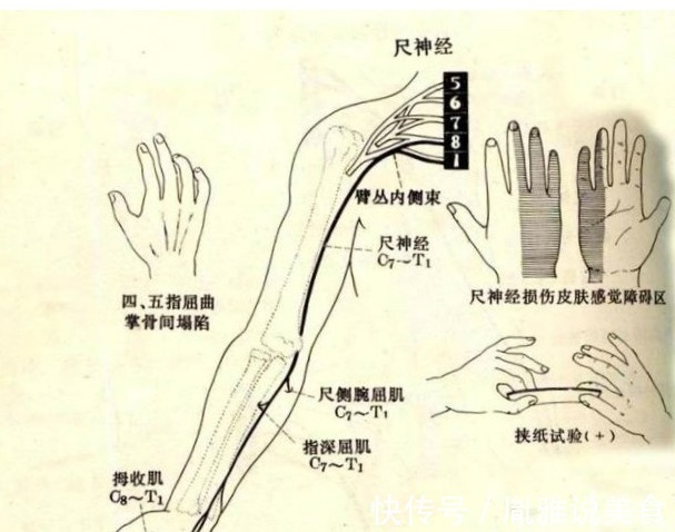 无名指|年轻女孩手指麻木几个月了，怀疑是颈椎病导致的，结果却不是