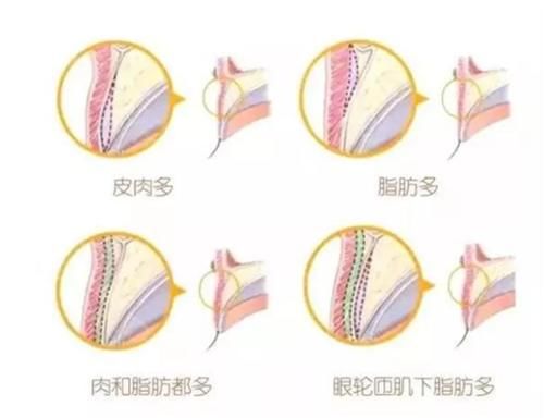 肿眼泡到双眼皮，你需要怎么做？