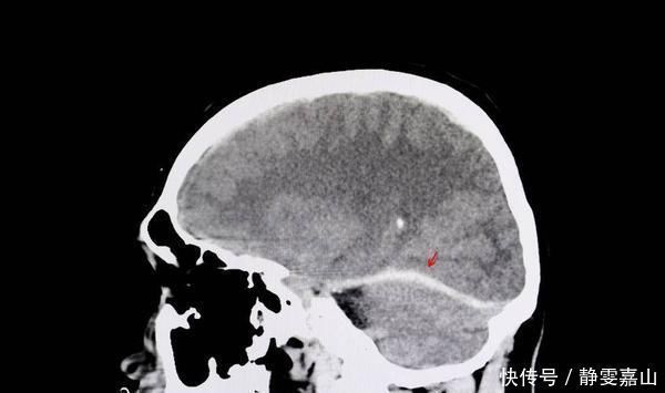 老年痴呆症|老年痴呆不可小觑,提醒:这些都是早期表现,提前预防很重要