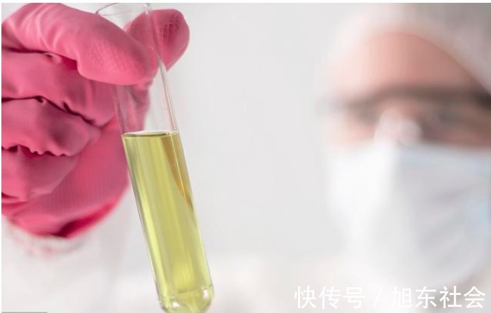 关节|红斑狼疮是不死的癌症,出现4个症状警惕红斑狼疮“上门”