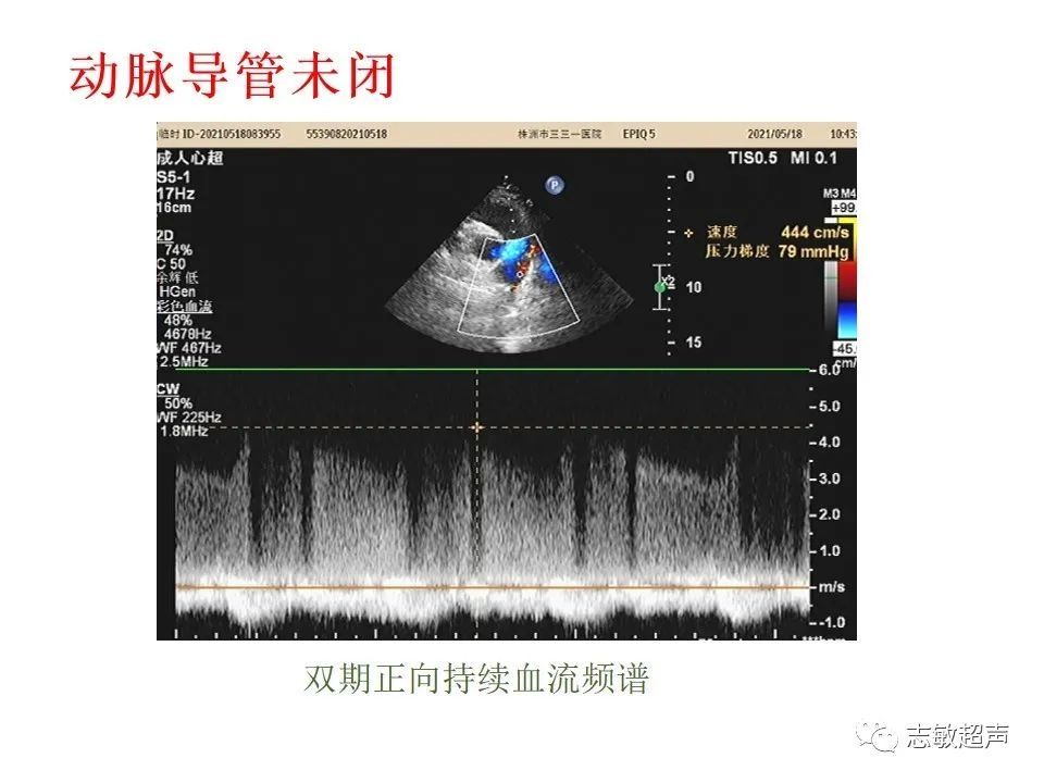 超声|肺动脉瓣周边异常血流的超声鉴别