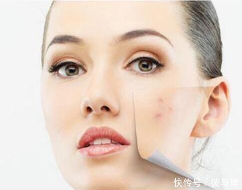 长痘怎么预防留痘印？做好7件事很重要！一定不可忽视