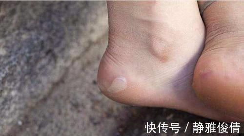 糖尿病|不管男女，脚出现3种异常，可能是糖尿病早期症状，别忽视