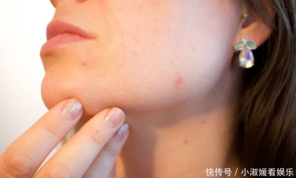 毛孔粗大如何缓解？专家建议做好这几点！